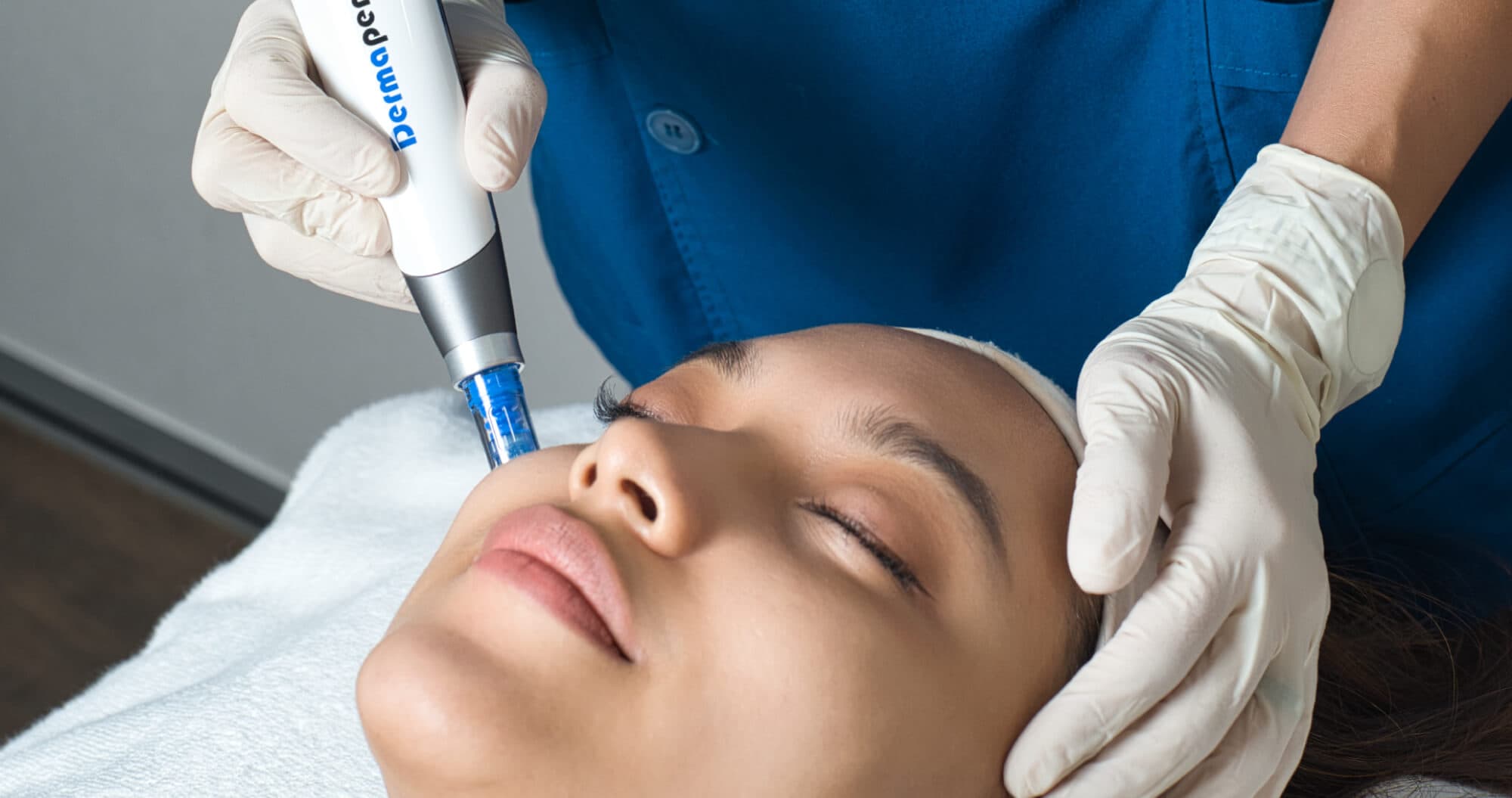 Dermapen4 for Acne Scars