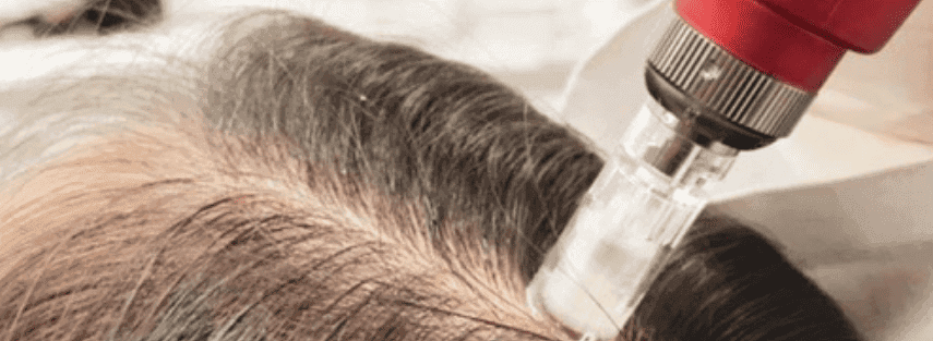 Dermapen4 for Hairloss