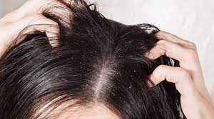 IV Therapy for Dandruff
