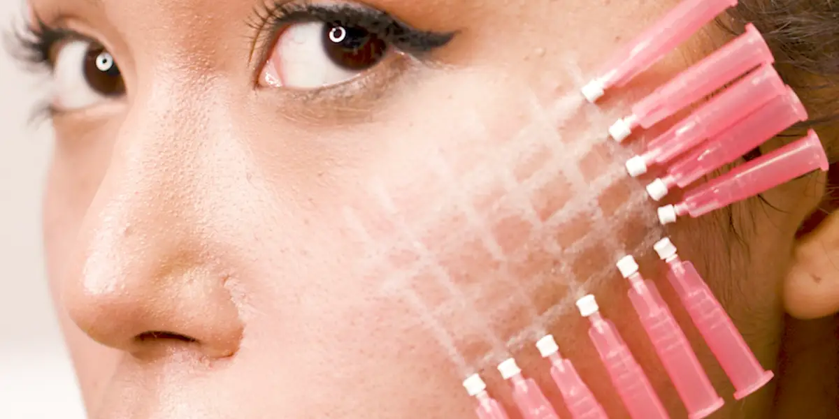 Mono Threads and Micro-infusion facial for Acne Scars