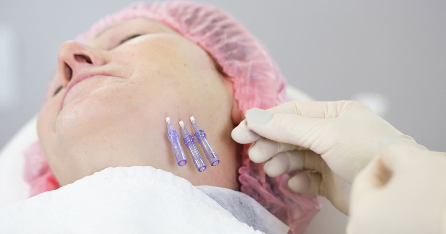 Mono Threads for Open Pores