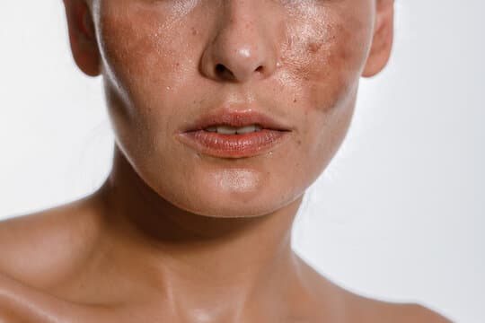 Pigmentation Treatment