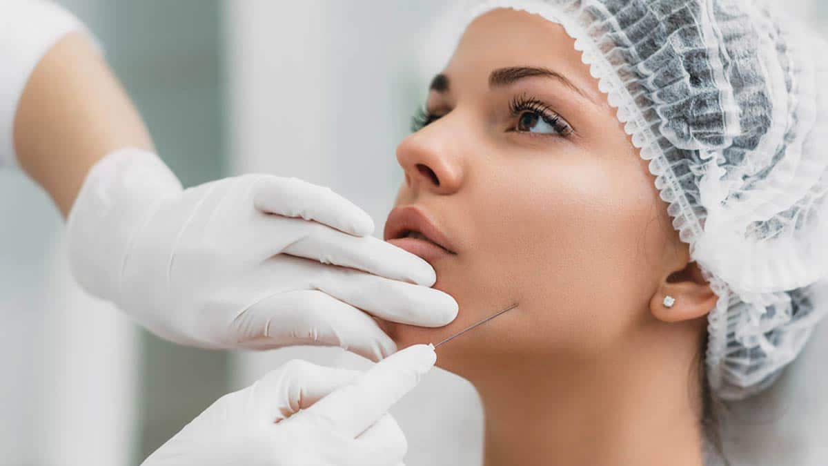 Thread Lift for Face Lift and Anti-Aging